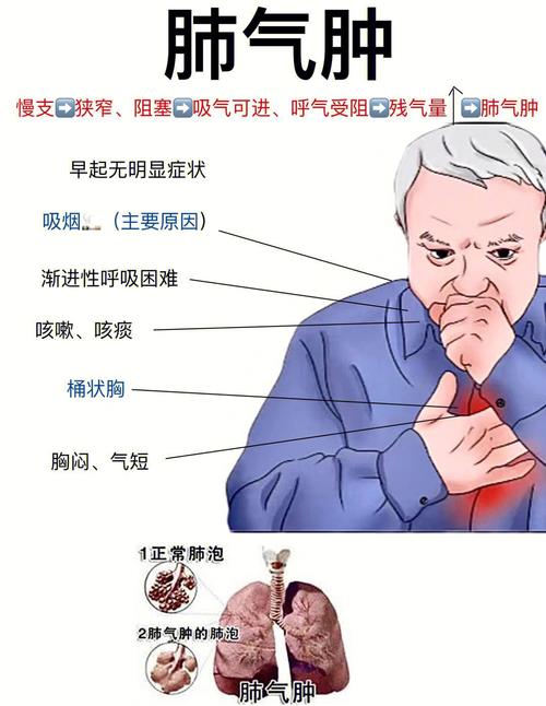 肺气肿是什么原因引起的的相关图片